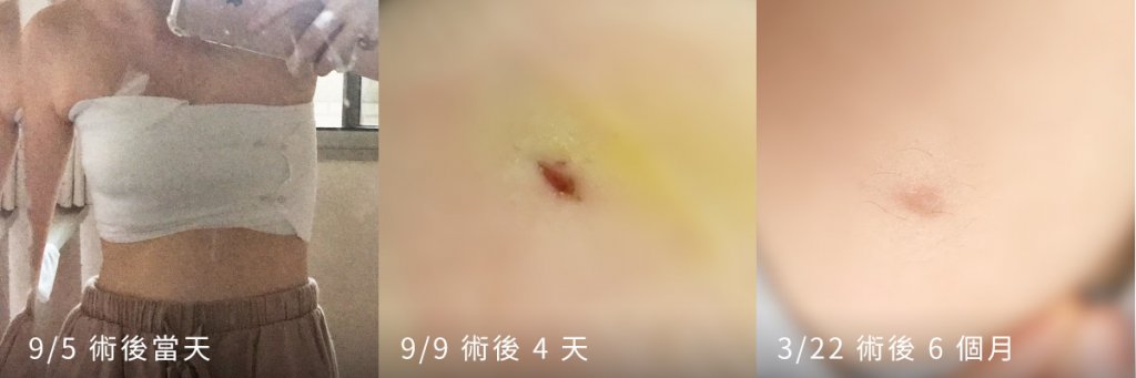 真空輔助乳房微創手術傷口紀錄照